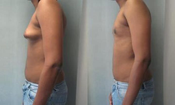 EFECTELE DAUNATOARE a consumului de CARNE DE PUI injectata cu HORMONI!2